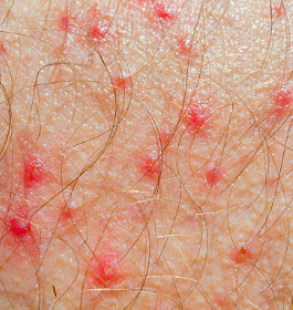 What Small Red Bumps on Your Skin May Mean
