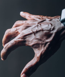 Visible Hand Veins: Common Reasons They Appear